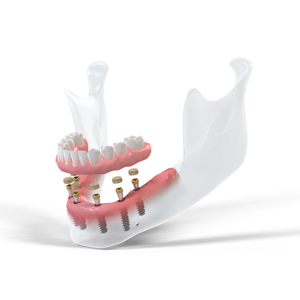 Implantes dentales en Carabanchel